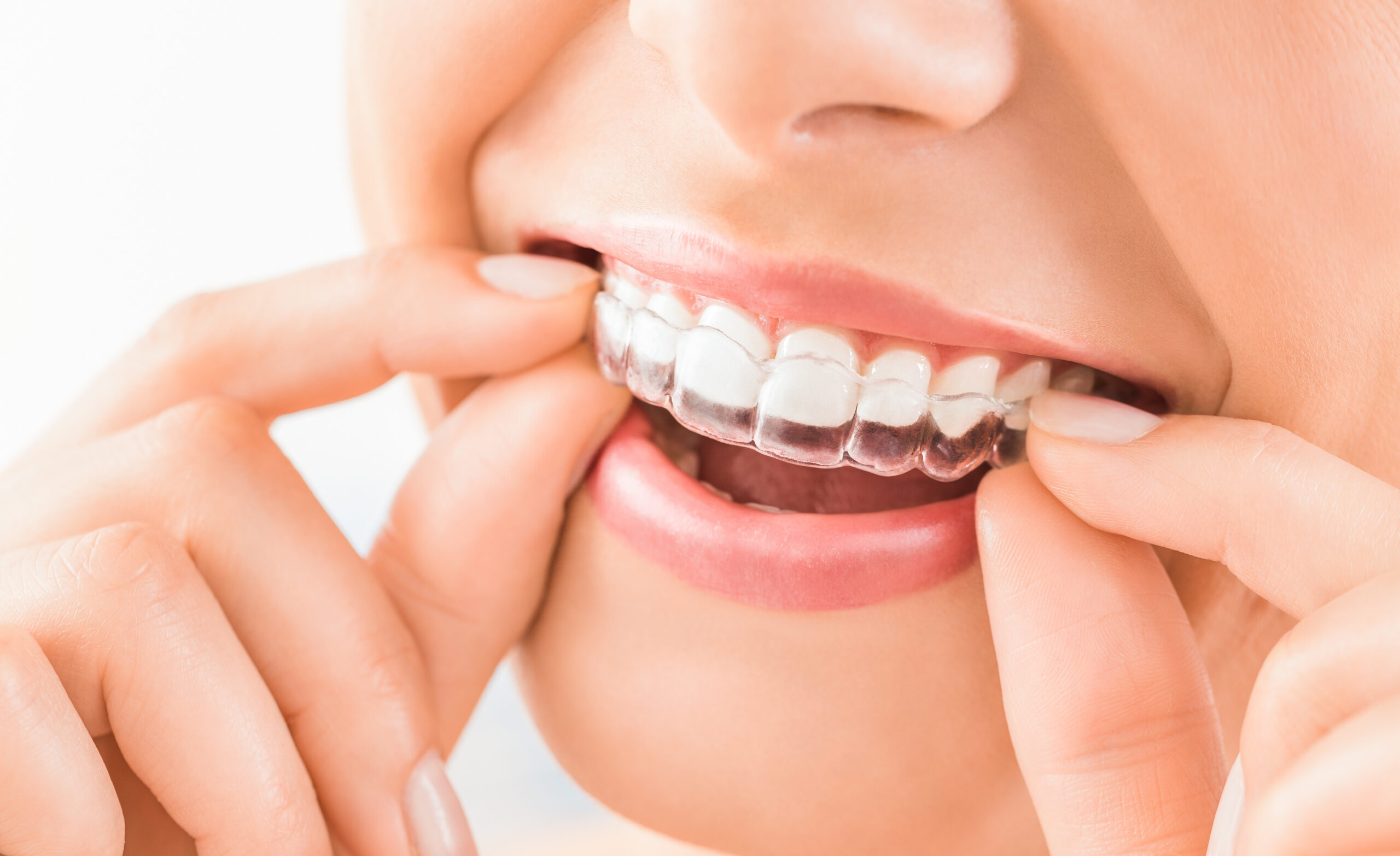 Dedicated Dental aligner orthodontics