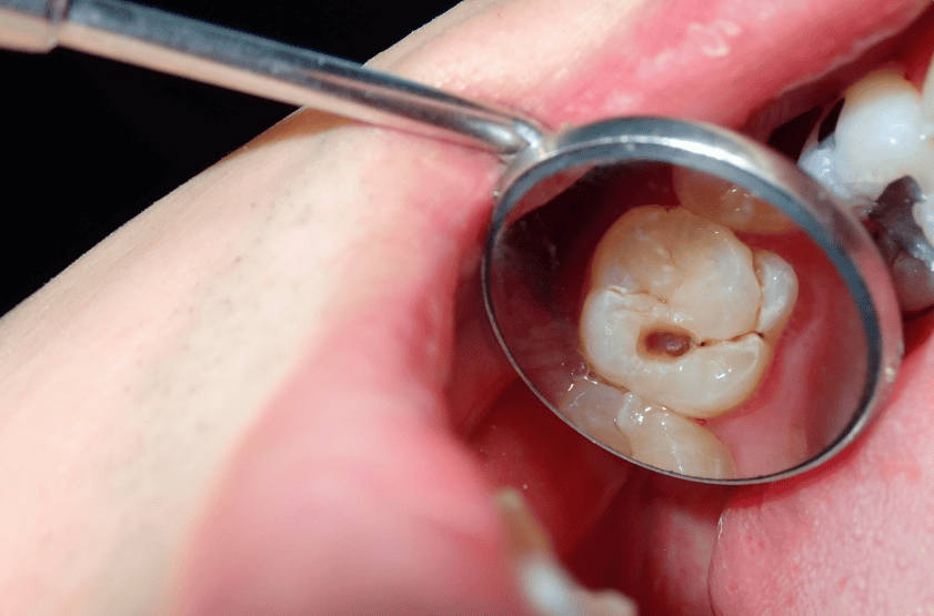Cavity Fillings in Stafford