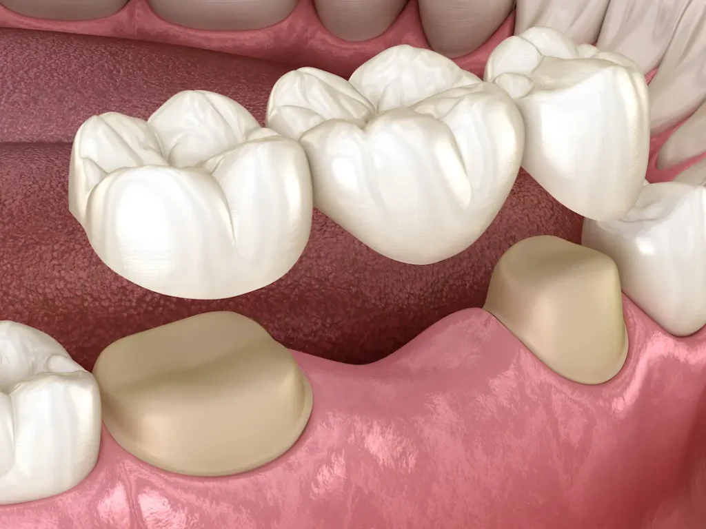 Dental Bridge in Stafford VA