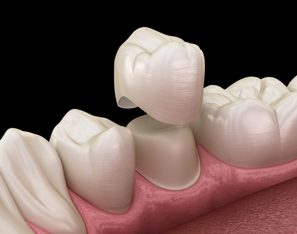 Protect and restore your teeth with custom dental crowns in Stafford, VA. Dedicated Dental offers natural-looking, durable solutions—call today to book!
