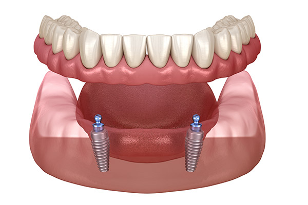 Missing teeth? Get permanent, natural-looking dental implants in Stafford, VA. Schedule your consultation with Dedicated Dental today!