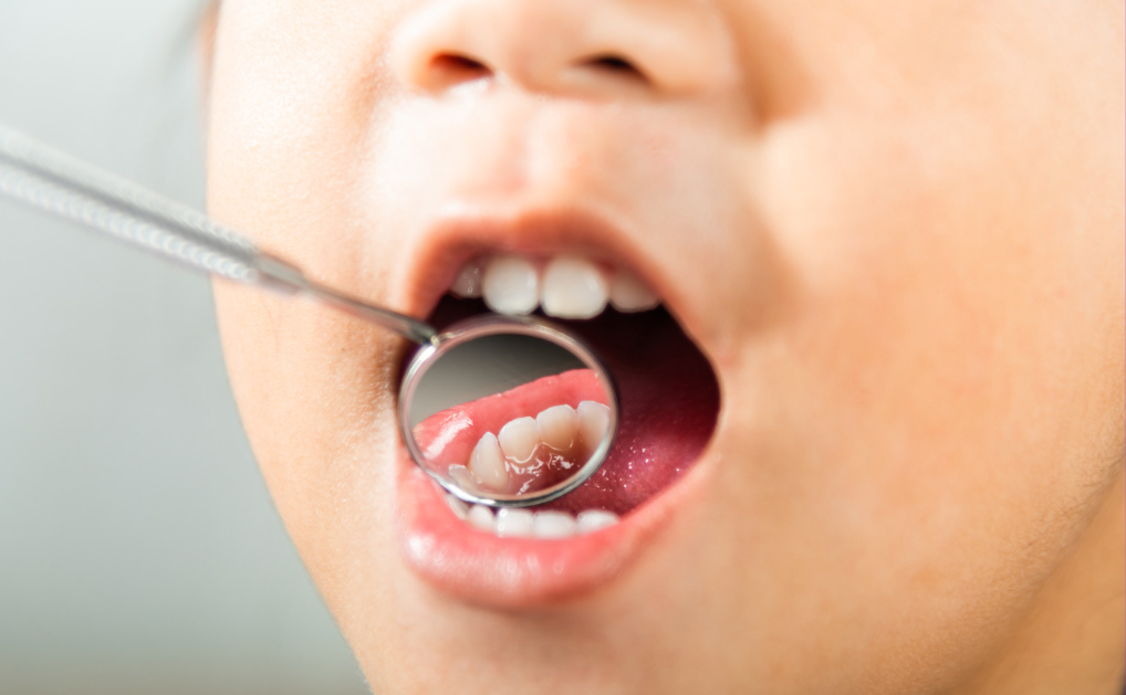 Dental Sealants in Stafford, VA | Dedicated Dental