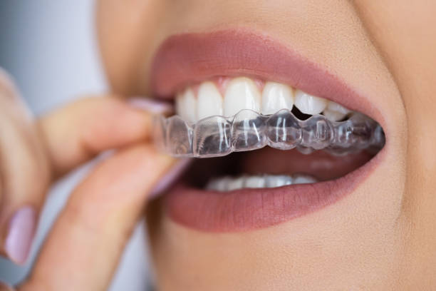 Invisalign in Stafford, VA | Straight Smiles Start Here!