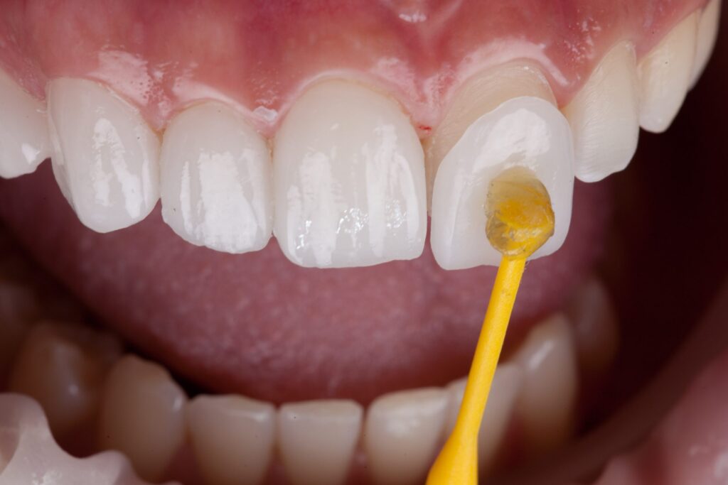 Veneers in Stafford, VA. Smile Makeovers at Dedicated Dental