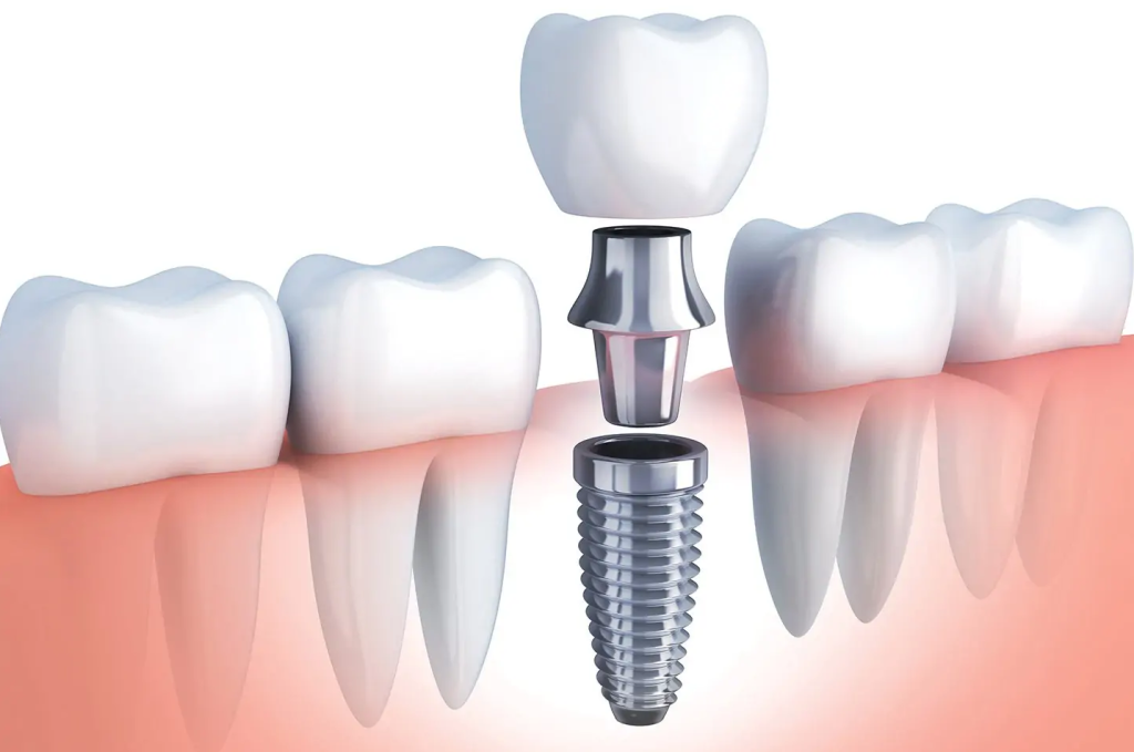 Dental Implants in Stafford VA